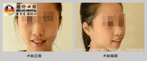 正畸即矫正牙齿畸形- 深覆合牙齿咬合图暗夜游