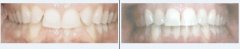 ѿ?Invisalign