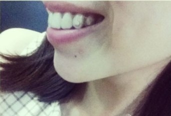 隐适美隐形牙箍 矫牙也臭美