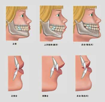 错合畸形指牙颌,颅面间关系不协调而引起的各种畸形,是指儿童在