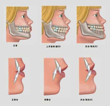 错颌畸形如何矫正?