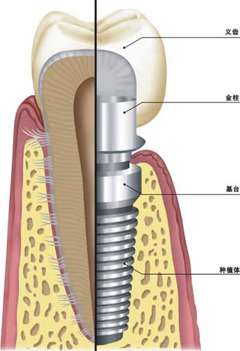 种植义齿的结构是怎样的?有什么优点?--广州德