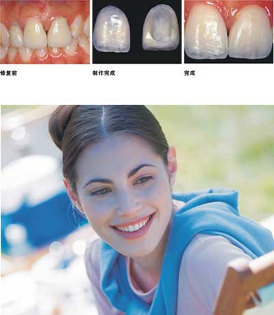 全瓷贴面哪里好?全瓷贴面四大优势