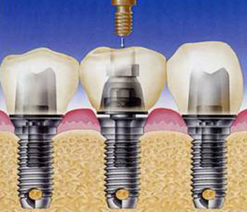 种植牙寿命的影响因素有哪些--广州德伦口腔
