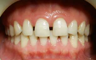 牙缝大的形成原因是什么?