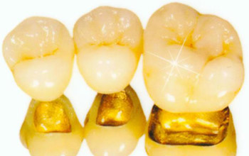 什么是贵金属烤瓷牙