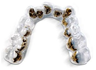 隐形舌侧正畸好不好?