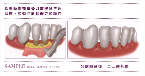 牙周病基础治疗之翻瓣手术_广州德伦口腔