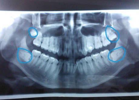 智慧牙一定要拔除吗?