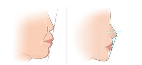 有一点龅牙怎么办?尽早矫正重获美丽--广州德伦口腔