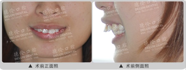 龅牙快速矫正案例:大龄剩女的痛