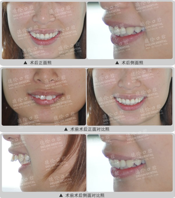 龅牙快速矫正案例:大龄剩女的痛