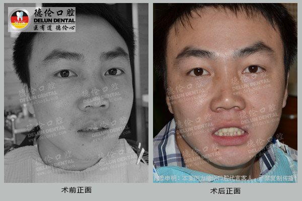 成人牙齿不齐牙齿美容修复矫正:牙齿关乎工作业绩