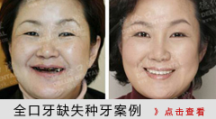 全口牙缺失种植牙案例
