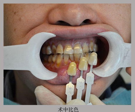 美容冠修复:四环素牙_广州德伦口腔