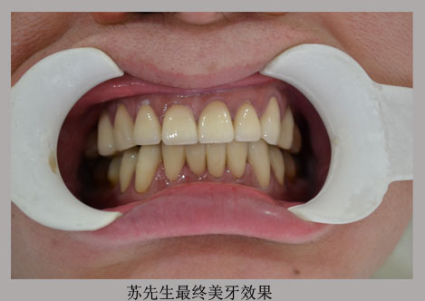 美容冠修复:四环素牙_广州德伦口腔