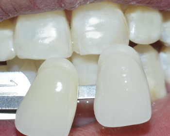 皓齿美白重塑帅气小伙_广州德伦口腔