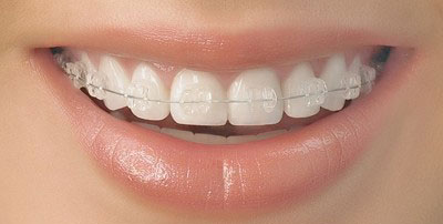 自锁托槽矫正技术有哪些优点?