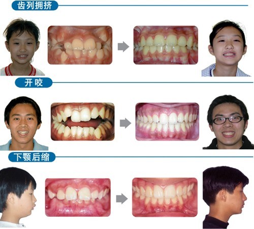 牙齿矫正的最佳年龄?--广州德伦口腔