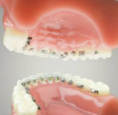 舌侧正畸的优点--广州德伦口腔