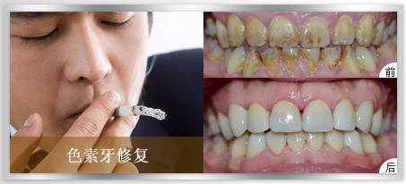 德伦3d瓷贴面色素牙美白牙齿案例, 点击咨询