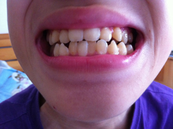 牙齿不齐有什么危害_广州德伦口腔