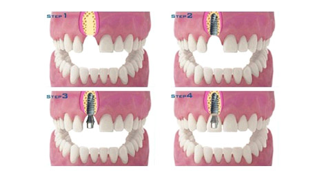 牙齿种植都有哪些步骤