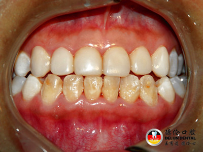 什么是四环素牙?四环素牙怎么办?_广州德伦口