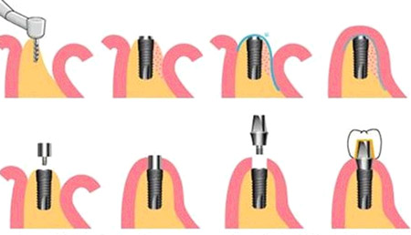 影响种植牙价格有哪些方面的因素