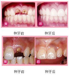 国内种植牙哪家医院最好