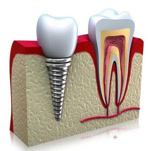 种植牙术前术后的注意事项--广州德伦口腔