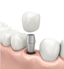 种植牙过程以及注意事项--广州德伦口腔