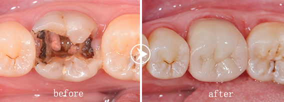 补牙的价格_苏州牙博士口腔