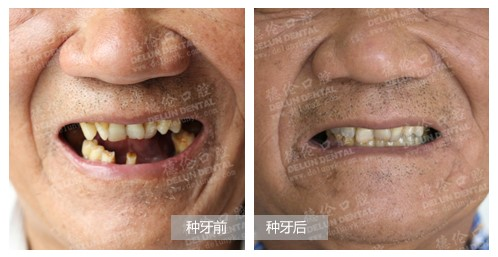 缺牙拖延症 从缺1颗到缺15颗