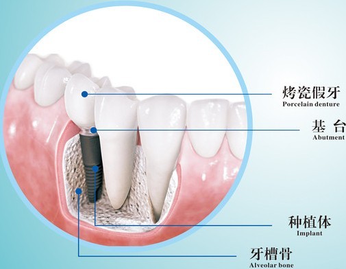 高分子固定牙是什么原理_高分子材料是什么(2)