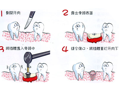关于种植牙的问题
