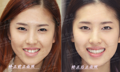 <em>矫正虎牙</em>的方法是什么_广州德伦口腔