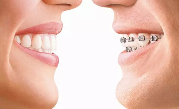 隐形牙齿矫正,美丽不刺眼