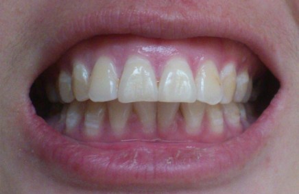 怎么护理牙齿的 110-15042911095J91.jpg