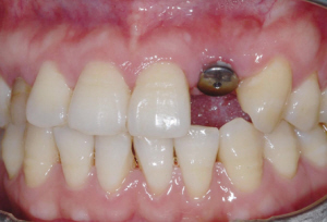 单颗牙齿种植后怎么护理 