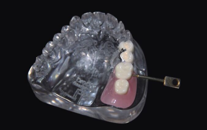 种植牙松动的原因有哪些呢--广州德伦口腔