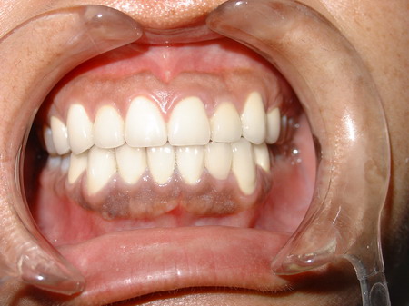 牙龈炎怎么办--user56576136的博客