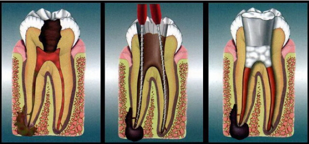 根管治疗后牙疼?治疗牙疼的方法 甲硝唑治疗牙