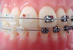 半隐形矫治比传统矫治好在哪