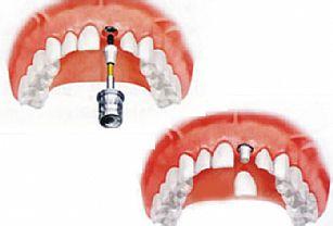 种牙最好的方案 115-160112102144429.jpg