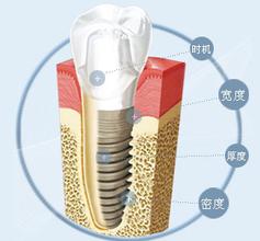 邹城玉红口腔医院老年人做种植牙到底好不好?
