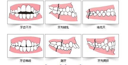 牙齿不齐又称错颌畸形,要表现为:牙齿排列不齐,上下牙弓间关系异常