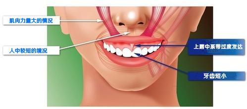 拒绝【露龈笑】 德伦口腔牙龈美学微整案例全
