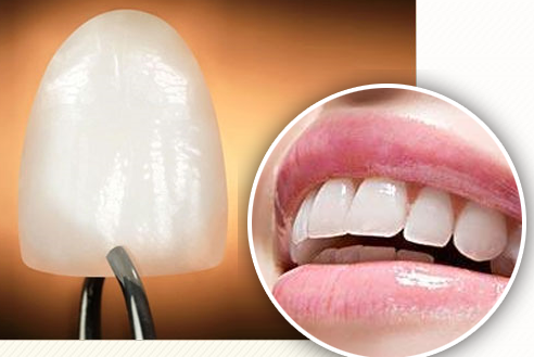 罗朝阳医师:牙贴面修复美白 让美牙变简单
