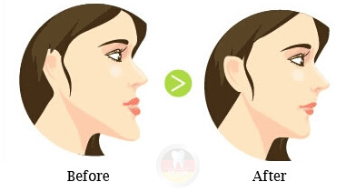 广州做地包天矫正牙齿一般要多少钱